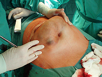 Hernienchirurgie